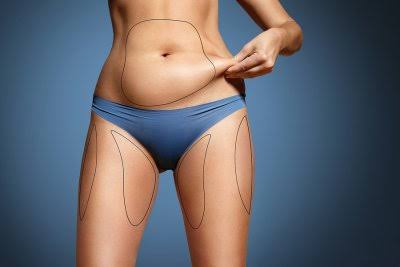 Liposuction: A Step-by-Step Guide